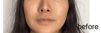 Lip Filler Before & After Patient #2677