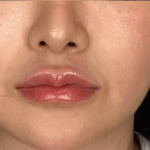 Lip Filler Before & After Patient #2677