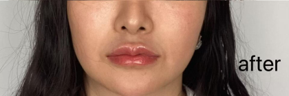Lip Filler Before & After Patient #2677