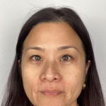 Derma-PRP Bio Filler Before & After Patient #2678