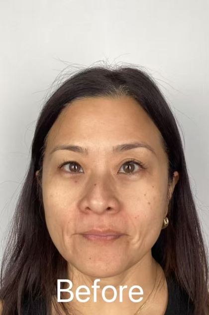 Derma-PRP Bio Filler Before & After Patient #2678