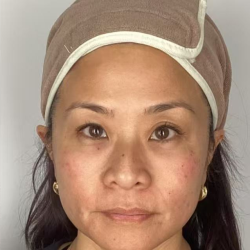 Derma-PRP Bio Filler Before & After Patient #2678