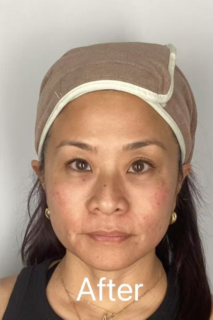 Derma-PRP Bio Filler Before & After Patient #2678